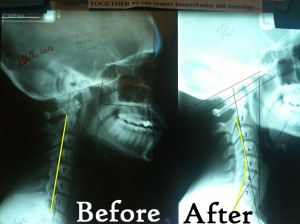 Before and After Pettibon Chiropractic X-rays