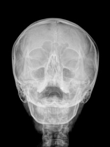 Sinus Infections Helped With Endonasal Cranial Adjusting - Dr Adam Fields