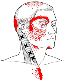 Trigger Point Therapy for headaches at Fields Family Chiropractic