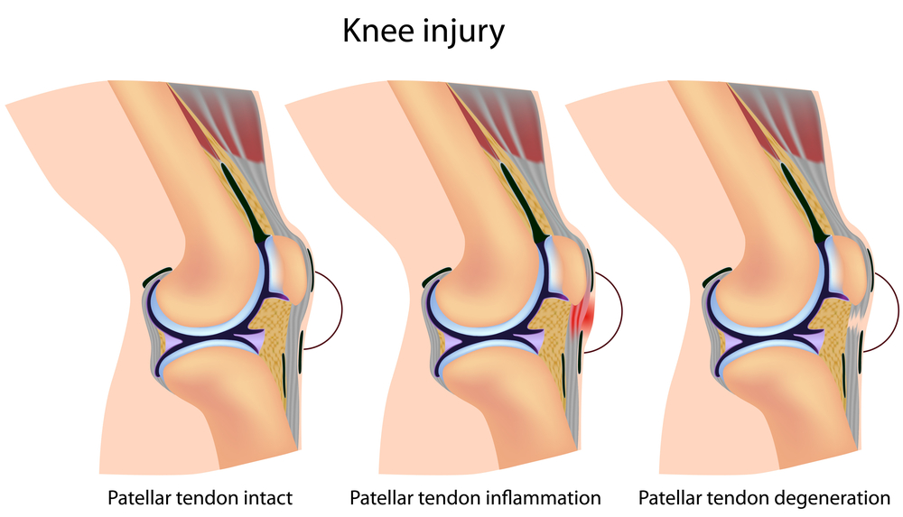 Patellar Tendiopathies can be helped with ESWT