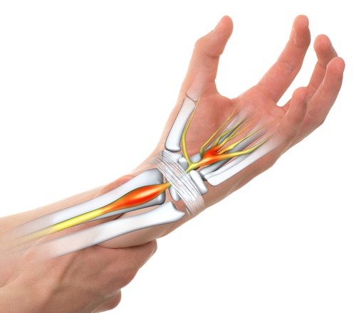 Carpal Tunnel Syndrome helped with ESWT