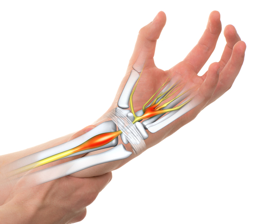 Carpal Tunnel Syndrome is now effectively treated with Extracorporeal ...