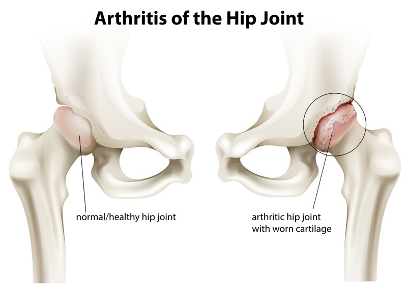 Arthritis of the hip socket and the role of ESWT
