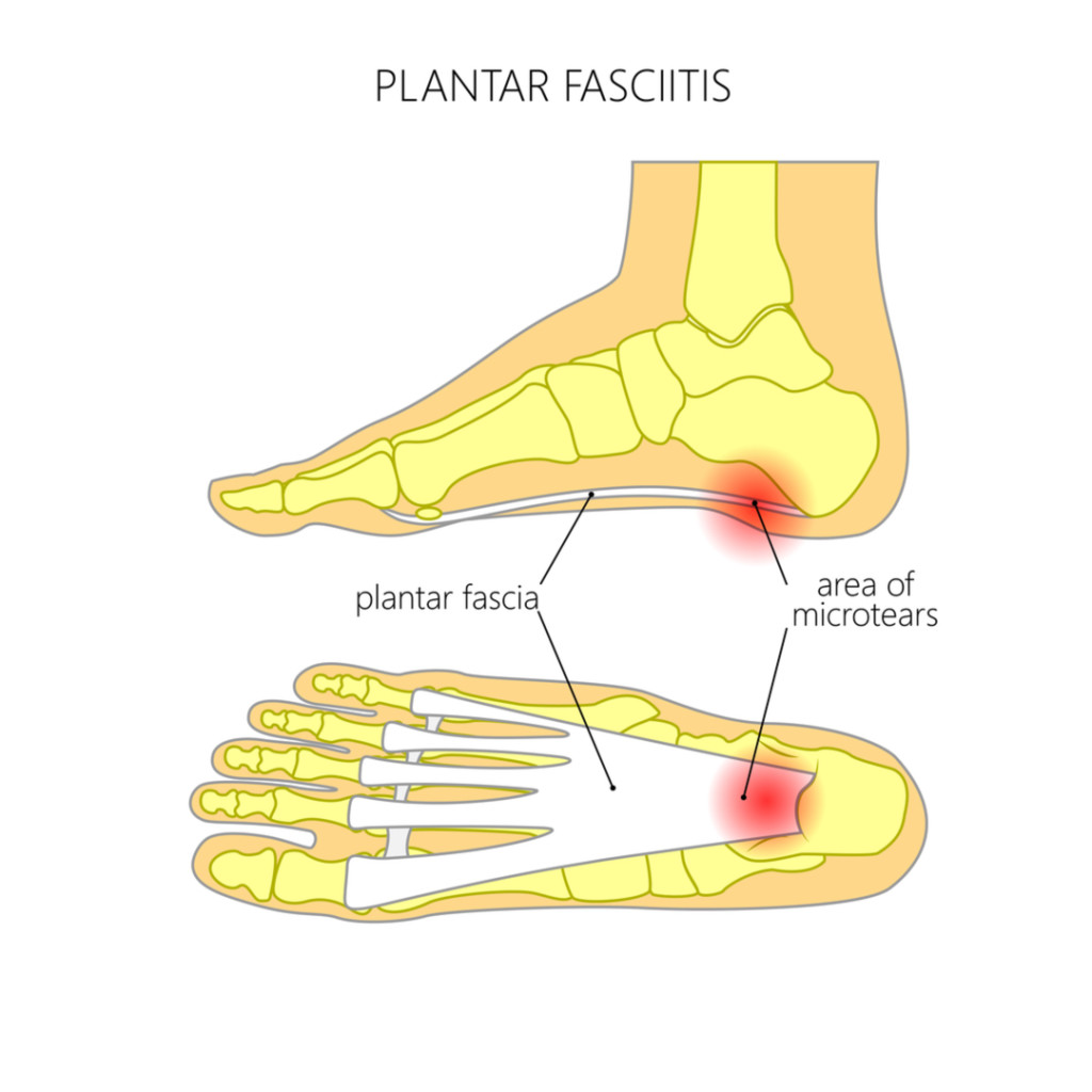 ESWT is the #1 FDA treatment for pantar fasciitis