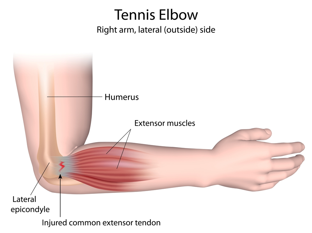 Tennis elbow is now effectively treated with ESWT