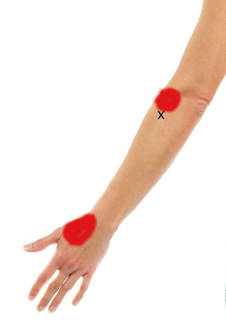 Trigger Point for Tennis Elbow can be helped with ESWT
