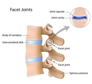 ESWT can help Lumbar Facet Joint Pain