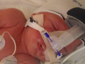 Premature Infant Given Prophylactic Antibiotics and X-rays